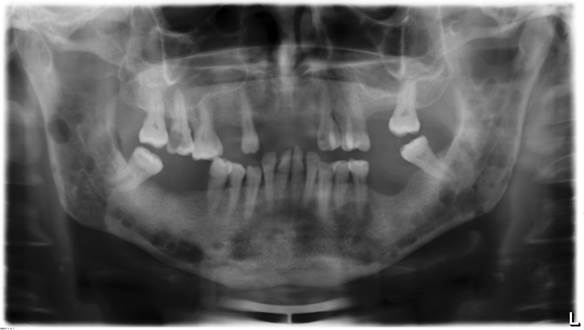 Osteomielites do complexo Maxilo Mandibular – Papaiz Diagnósticos